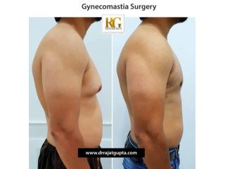 how-do-i-know-if-i-have-gynecomastia-small-0