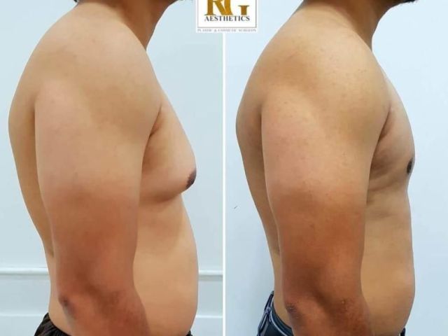 how-do-i-know-if-i-have-gynecomastia