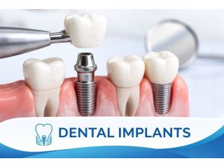 dental-implants-pune-permanent-tooth-replacement-solutions-small-0
