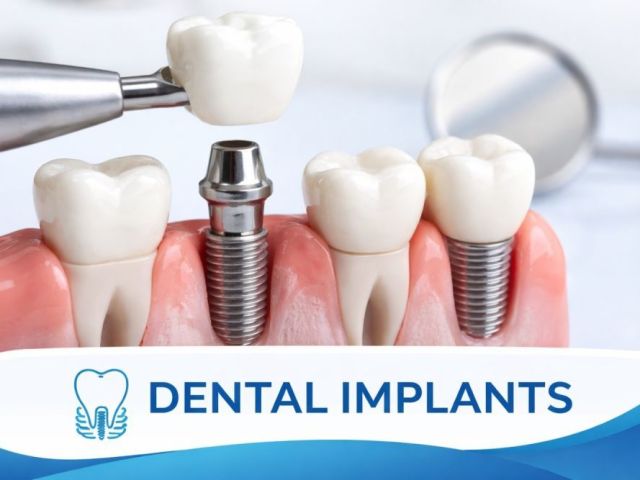 dental-implants-pune-permanent-tooth-replacement-solutions