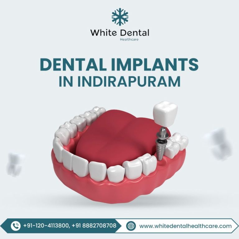 trusted-dental-implants-in-indirapuram-for-a-perfect-smile-big-0