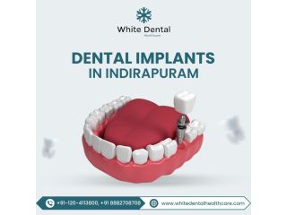 trusted-dental-implants-in-indirapuram-for-a-perfect-smile-small-0