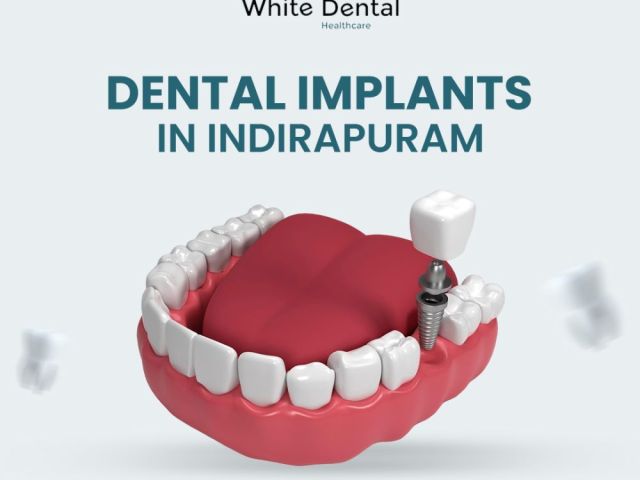 trusted-dental-implants-in-indirapuram-for-a-perfect-smile
