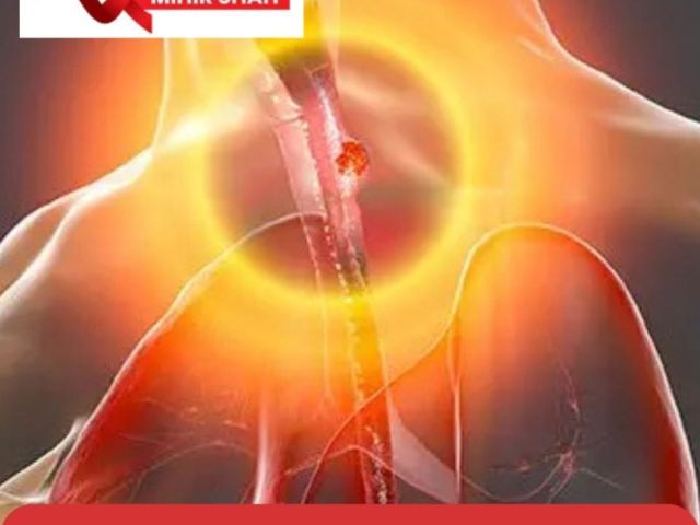 top-esophageal-cancer-treatment-in-ahmedabad-dr-mihir-shah