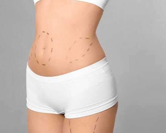how-much-is-liposuction-surgery-a-clear-cost-breakdown