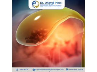 gallbladder-cancer-surgery-in-ahmedabad-with-latest-technology-small-0