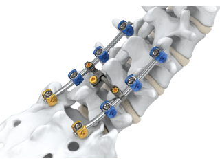 advanced-spine-fixation-surgeon-in-kolkata-small-0