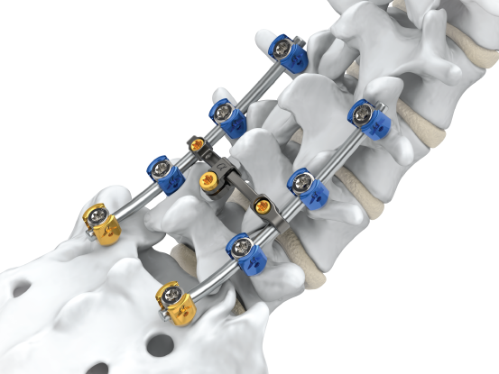 advanced-spine-fixation-surgeon-in-kolkata
