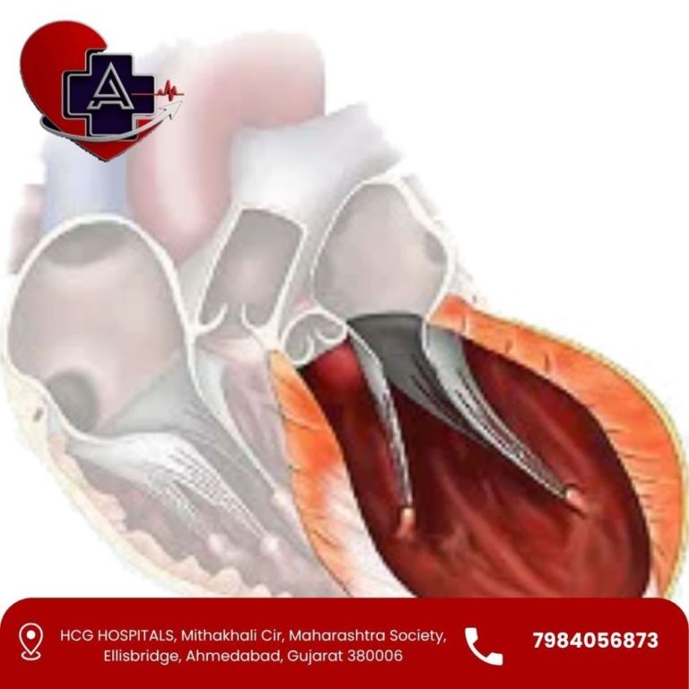 left-ventricular-aneurysm-treatment-in-ahmedabad-big-0