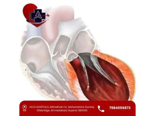 left-ventricular-aneurysm-treatment-in-ahmedabad-small-0