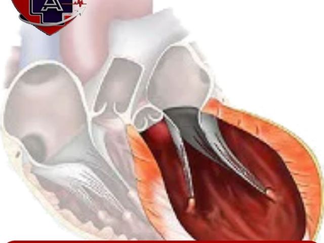 left-ventricular-aneurysm-treatment-in-ahmedabad