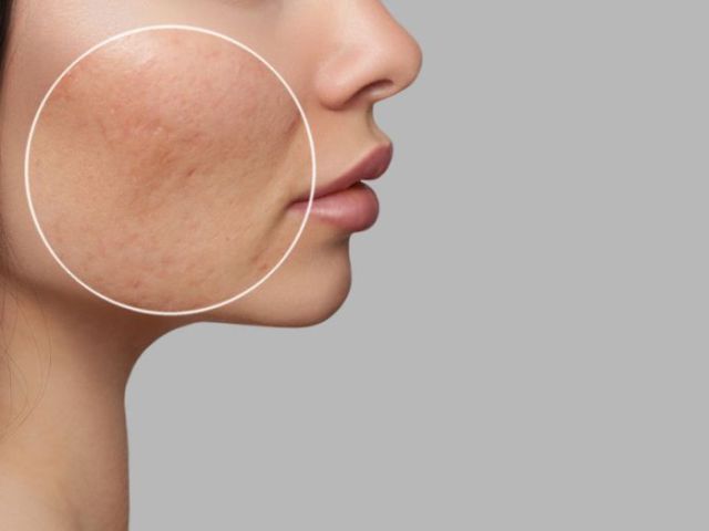 acne-treatment-in-vasant-kunj-that-delivers-lasting-results