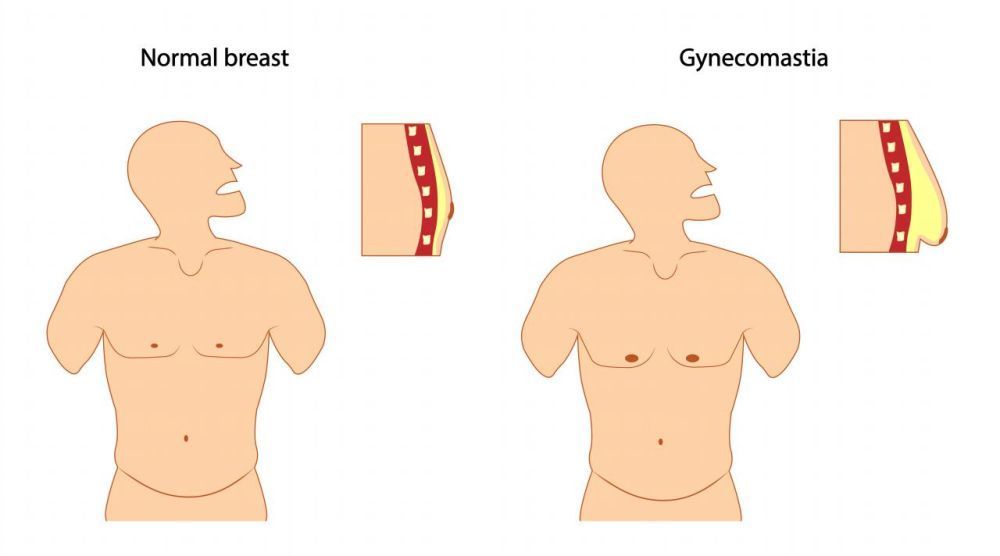 gynecomastia-surgery-in-delhi-get-rid-of-male-chest-fat-big-0