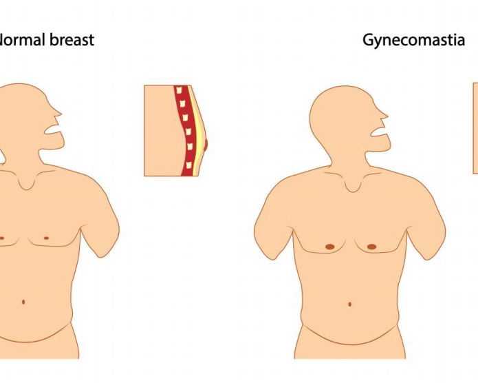 gynecomastia-surgery-in-delhi-get-rid-of-male-chest-fat