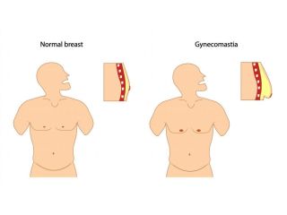 gynecomastia-surgery-in-delhi-get-rid-of-male-chest-fat-small-0