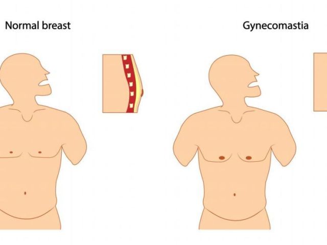 gynecomastia-surgery-in-delhi-get-rid-of-male-chest-fat