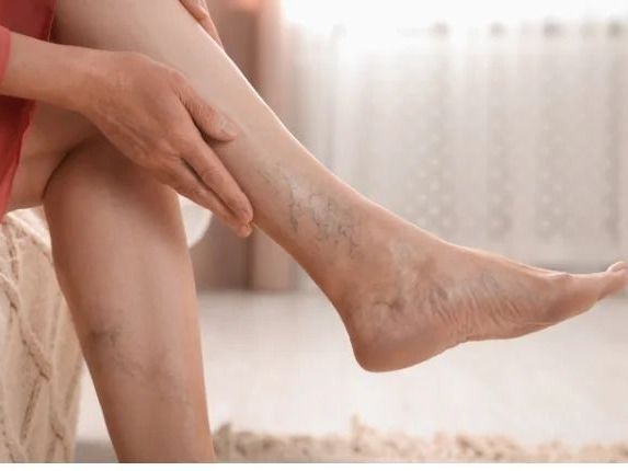 minimally-invasive-solutions-for-deep-vein-thrombosis