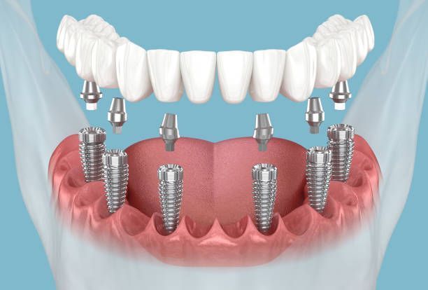 dental-implant-cost-near-me-price-offers-consultation-big-0