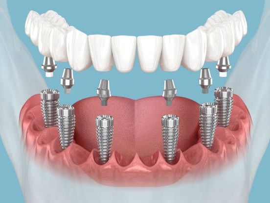 dental-implant-cost-near-me-price-offers-consultation