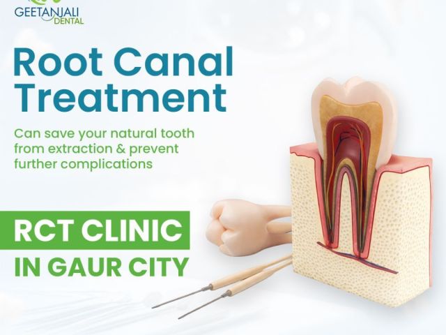rct-clinic-in-gaur-city-for-painless-root-canal-treatments