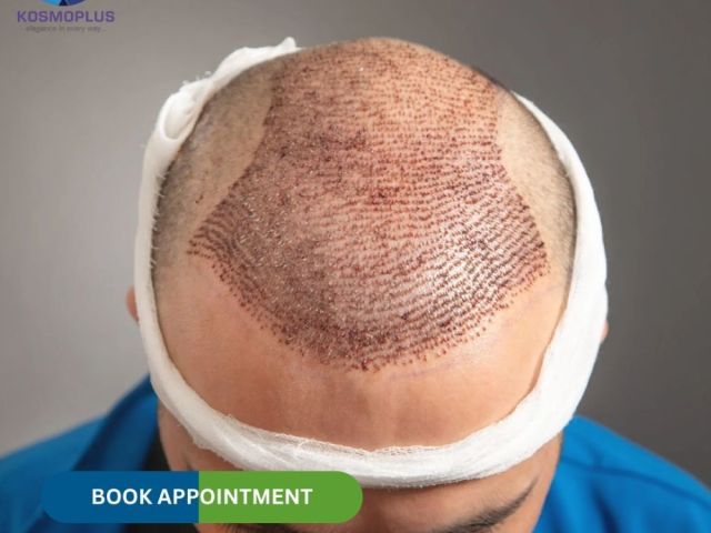 look-younger-instantly-with-hair-transplant-in-ahmedabad