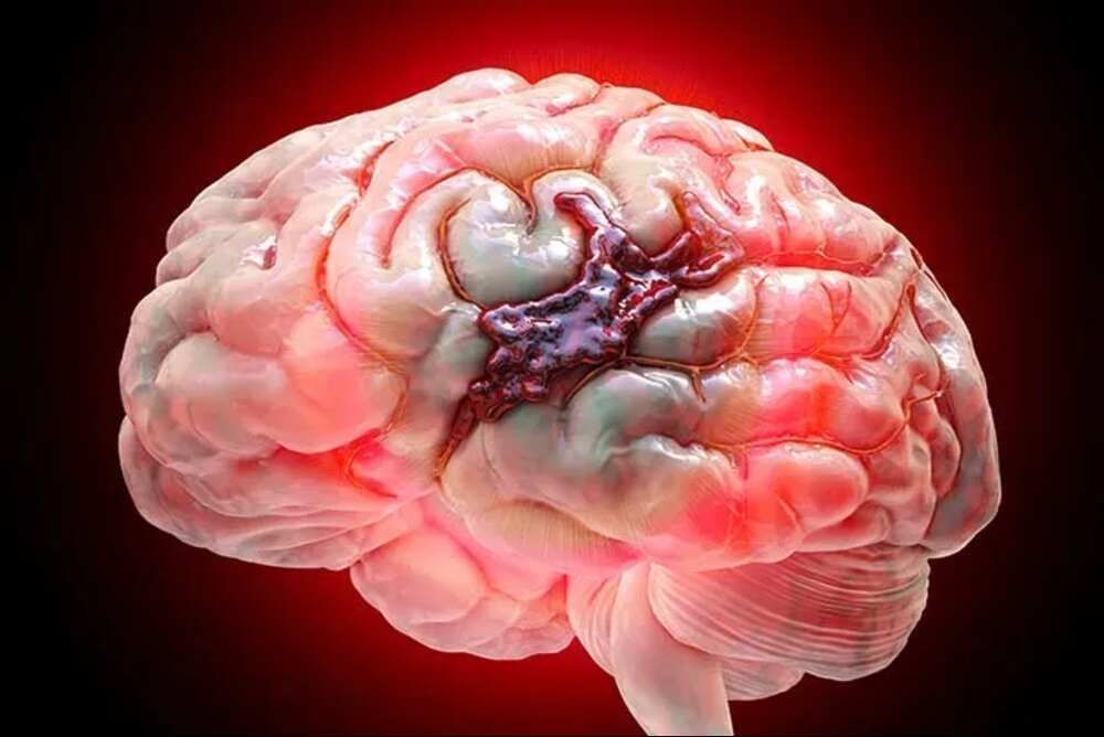 safe-brain-hemorrhage-operation-by-experts-big-0