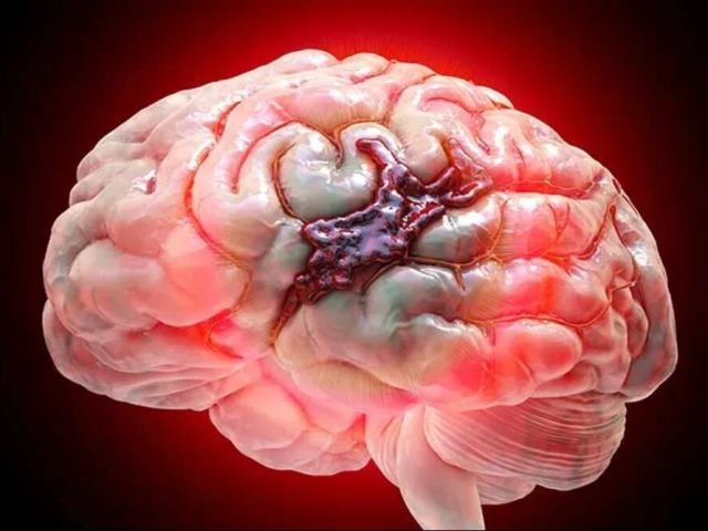 safe-brain-hemorrhage-operation-by-experts