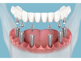 tooth-implant-cost-in-pune-affordable-dental-implants-small-0