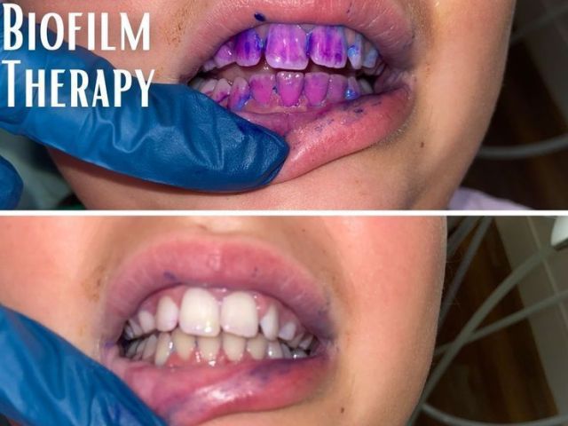 advanced-dental-biofilm-therapy-in-trivandram-at-smilesculptor