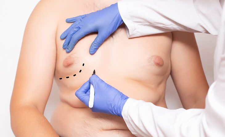 gynecomastia-and-liposuction-surgery-do-you-need-both-big-0