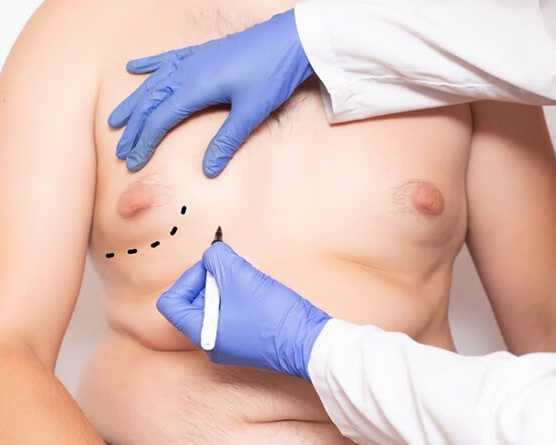 gynecomastia-and-liposuction-surgery-do-you-need-both