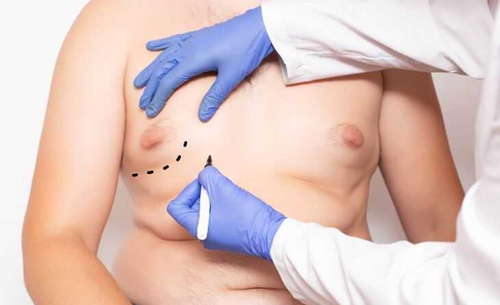 gynecomastia-and-liposuction-surgery-do-you-need-both-big-0