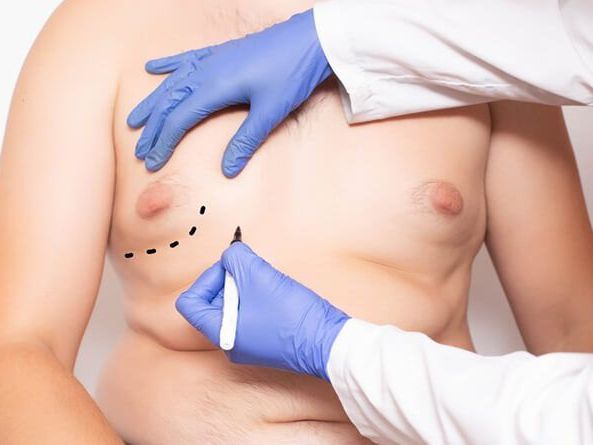 gynecomastia-and-liposuction-surgery-do-you-need-both