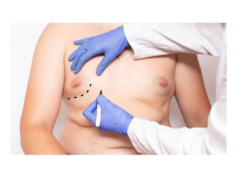 gynecomastia-and-liposuction-surgery-do-you-need-both-small-0