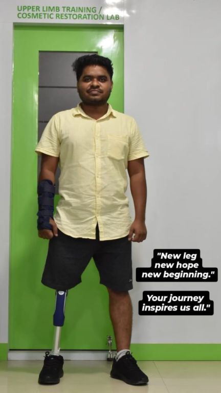 best-artificial-leg-in-hyderabad-carevale-prosthetics-big-3