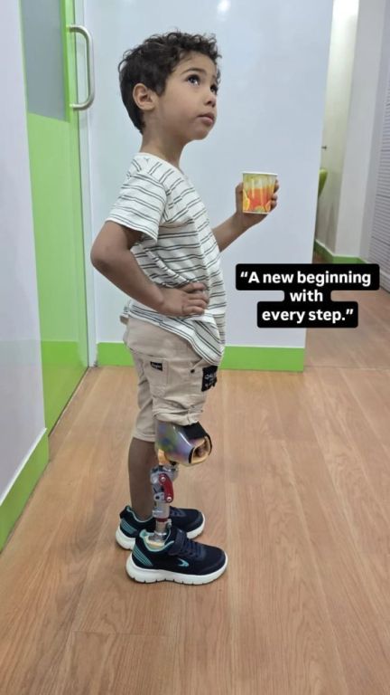 best-artificial-leg-in-hyderabad-carevale-prosthetics-big-2