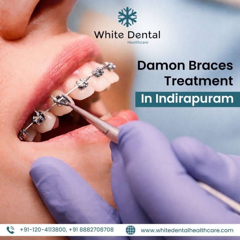 damon-braces-treatment-in-indirapuram-for-perfect-smile-big-0