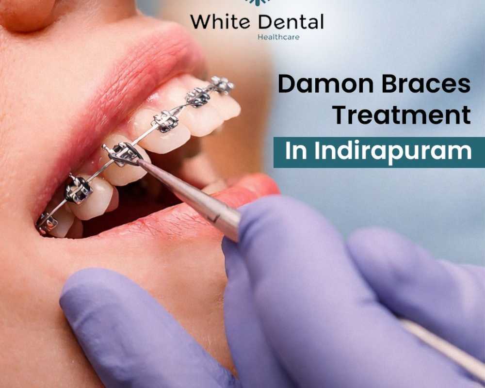 damon-braces-treatment-in-indirapuram-for-perfect-smile