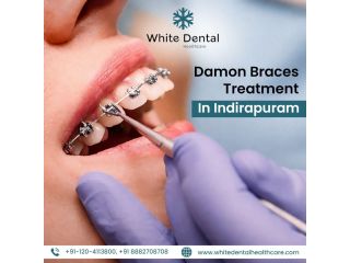 damon-braces-treatment-in-indirapuram-for-perfect-smile-small-0