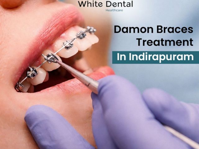damon-braces-treatment-in-indirapuram-for-perfect-smile