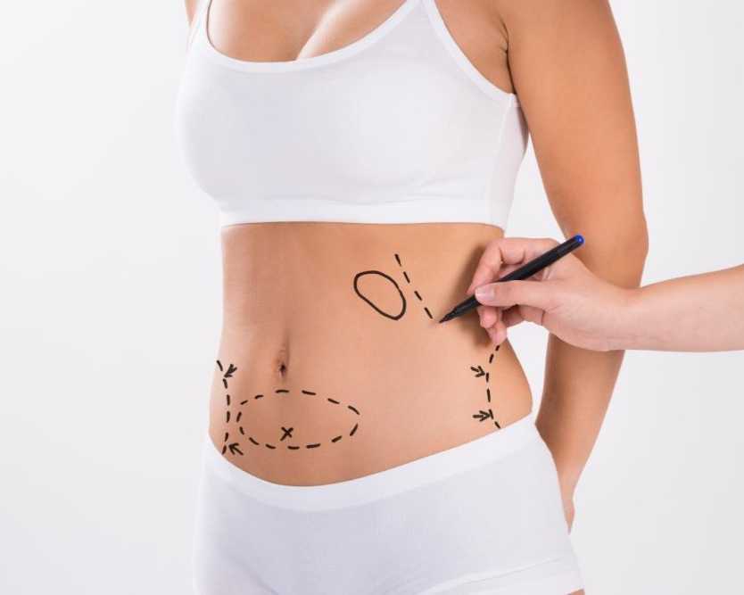 best-tummy-tuck-surgery-in-delhi-for-a-flat-firm-abdomen