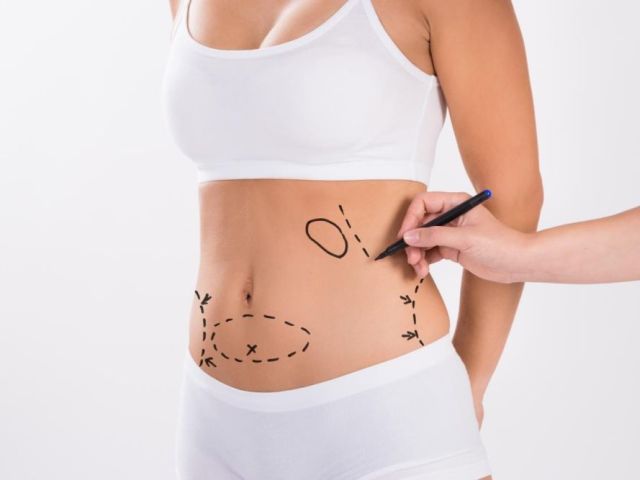 best-tummy-tuck-surgery-in-delhi-for-a-flat-firm-abdomen