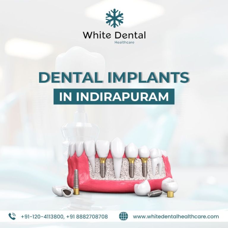 dental-implants-in-indirapuram-for-healthy-and-strong-teeth-big-0