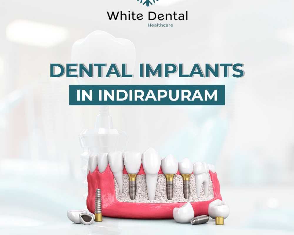 dental-implants-in-indirapuram-for-healthy-and-strong-teeth