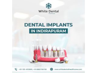 dental-implants-in-indirapuram-for-healthy-and-strong-teeth-small-0