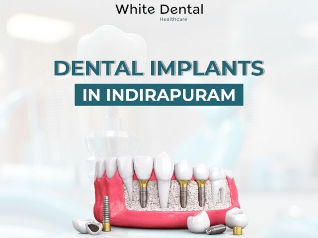 dental-implants-in-indirapuram-for-healthy-and-strong-teeth