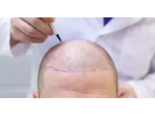 hair-transplant-in-kondapur-a-modern-solution-for-hair-small-0