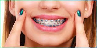 removable-teeth-braces-in-dombivli-comfortable-care-big-0