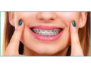 removable-teeth-braces-in-dombivli-comfortable-care-small-0