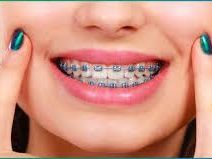 removable-teeth-braces-in-dombivli-comfortable-care